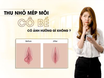 Thu Nhỏ Mép Môi Cô Bé Có Ảnh Hưởng Gì Không