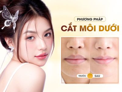 Cắt Môi Dưới