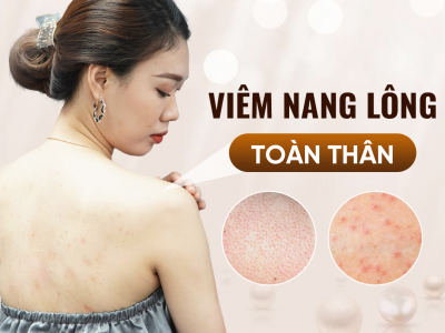 Điều Trị Viêm Nang Lông Toàn Thân 