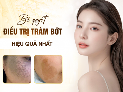 Điều Trị Chàm Bớt Bẩm Sinh Hiệu Quả 