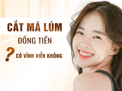 Cắt Má Lúm Đồng Tiền Có Vĩnh Viễn Không?