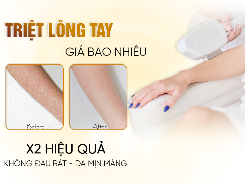 Triệt Lông Tay Giá Bao Nhiêu? 