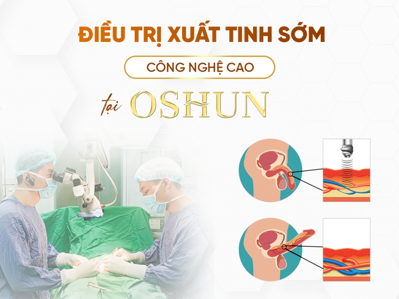 Điều Trị Xuất Tinh Sớm Công Nghệ Cao Tại Oshun