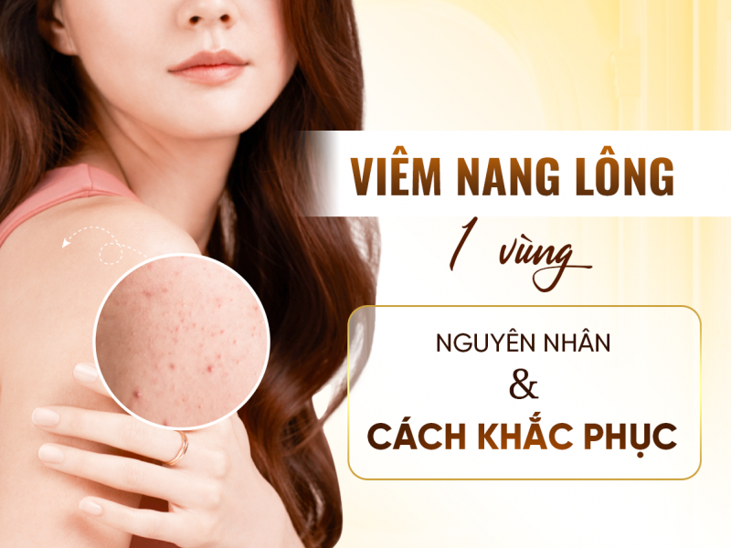 Điều Trị Viêm Nang Lông 1 Vùng